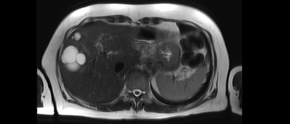 Querschnitt durch einen Oberkörper: Auf diesem MR-Bild sind links am Rand mehrere Zysten der Leber als weiße Blasen zu erkennen.